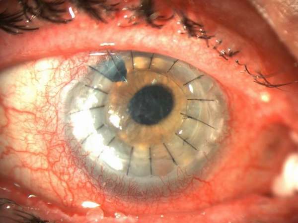 фото кератопластики глаза